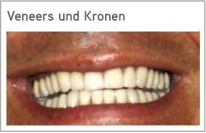 Veneers Kosten