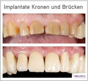 implantate-ungarn