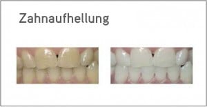 Zahnaufhellung - Bleaching - Bleichen