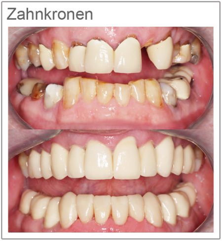 E Max Krone Nachteile